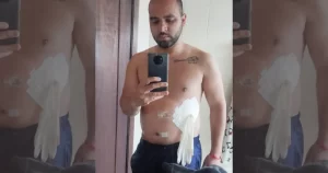 Médico coloca luva cirúrgica no lugar de bolsa de colostomia em paciente